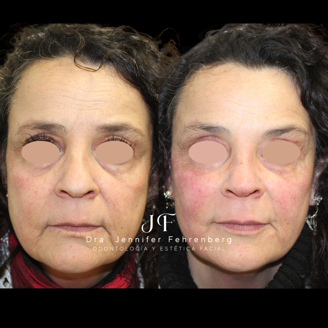 Full Face Armonización